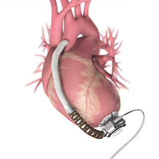 ventricular-assist-device-1290x1290